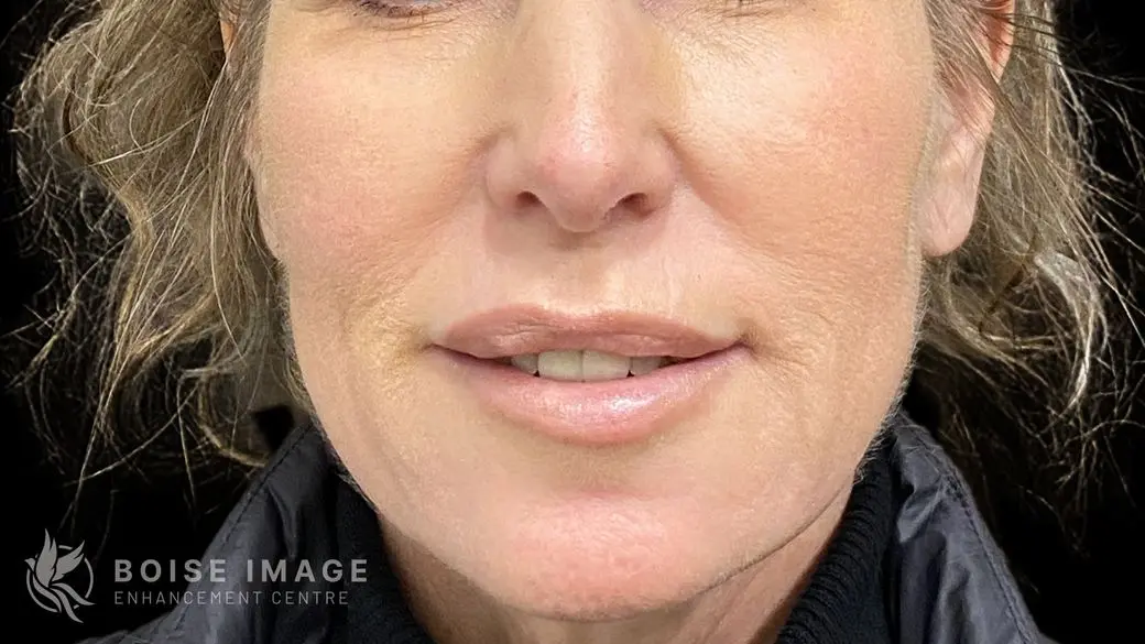 Lower Face After