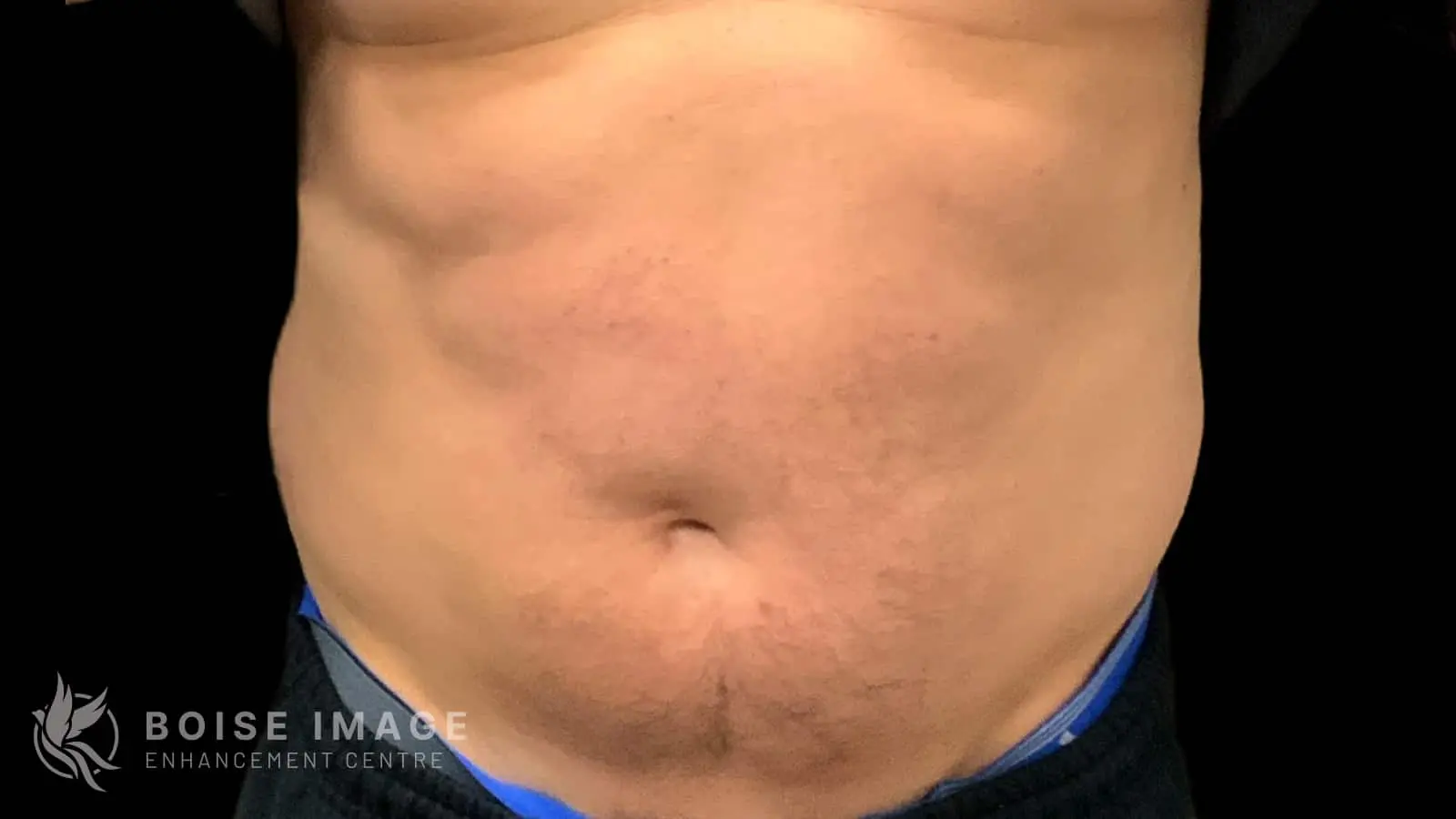 Abdomen After