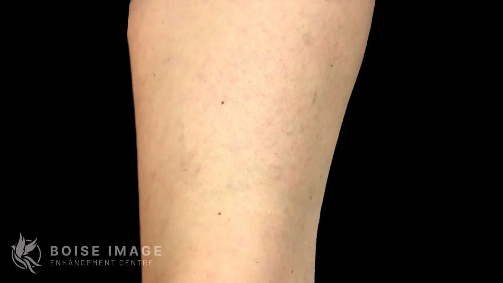 Anterior Thigh After