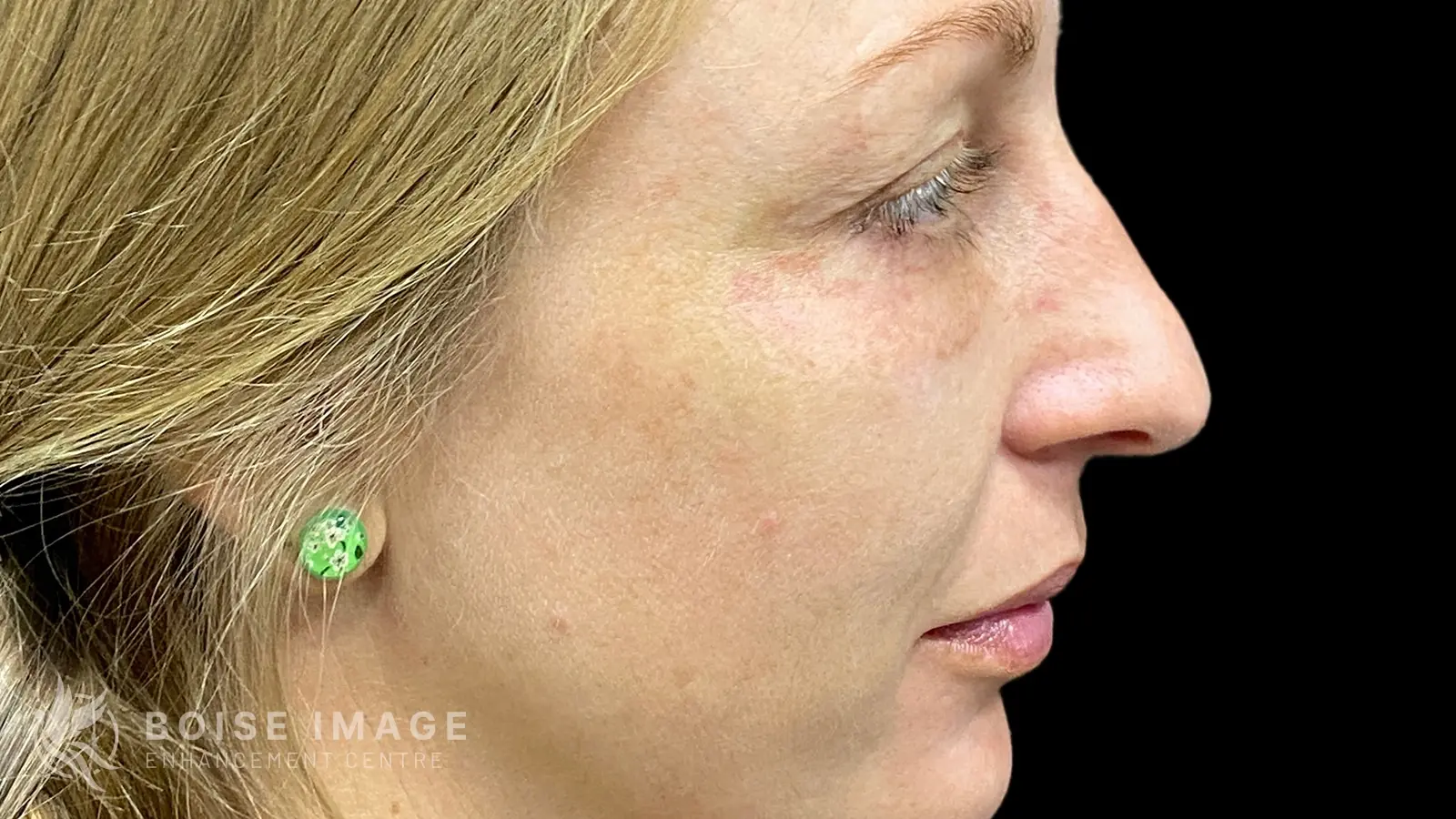 Facial Balancing Side Before