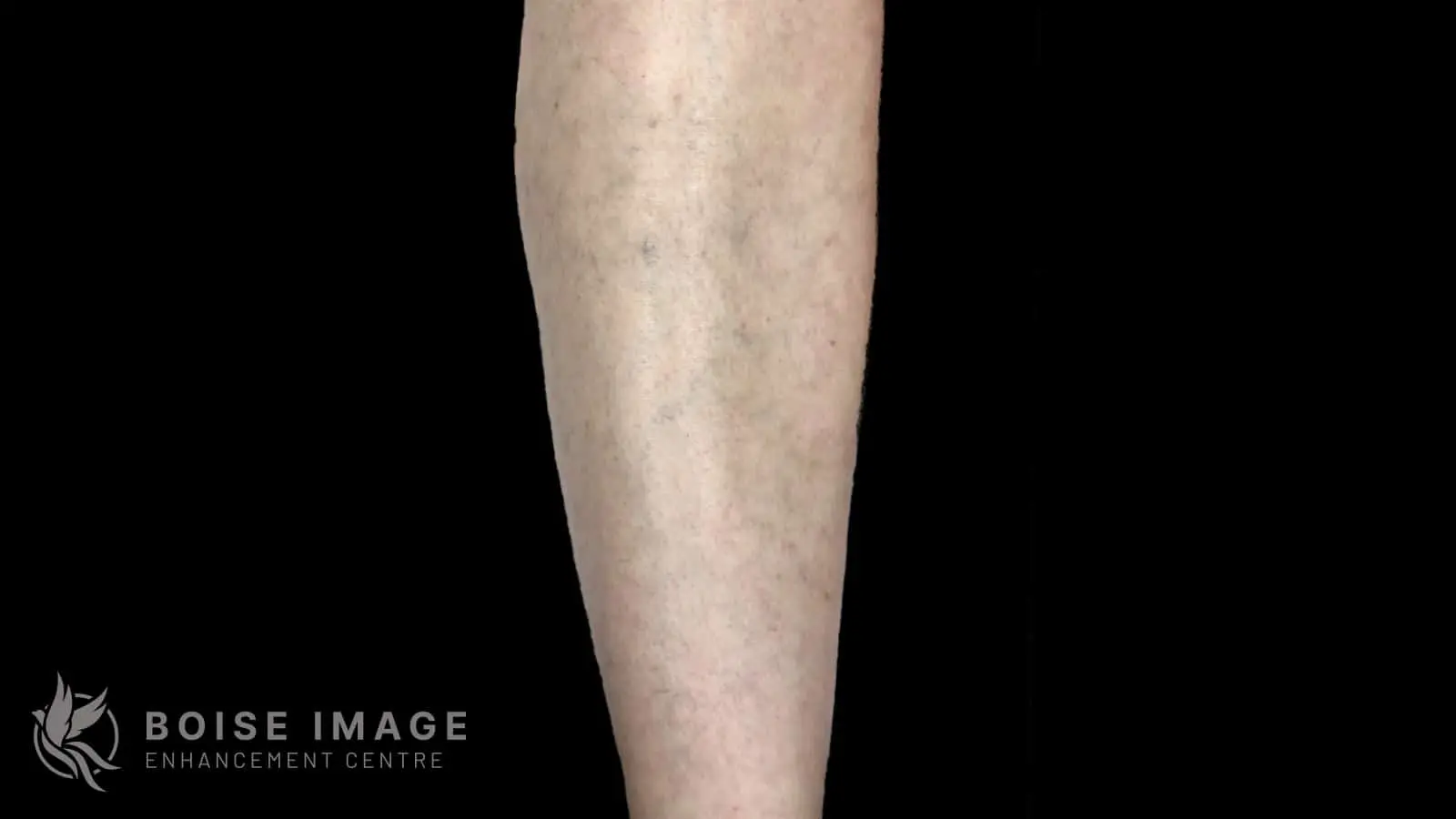 Anterior Thigh Before