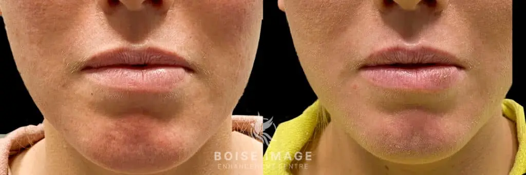 Lip Filler Dissolving Before and After - Treatment