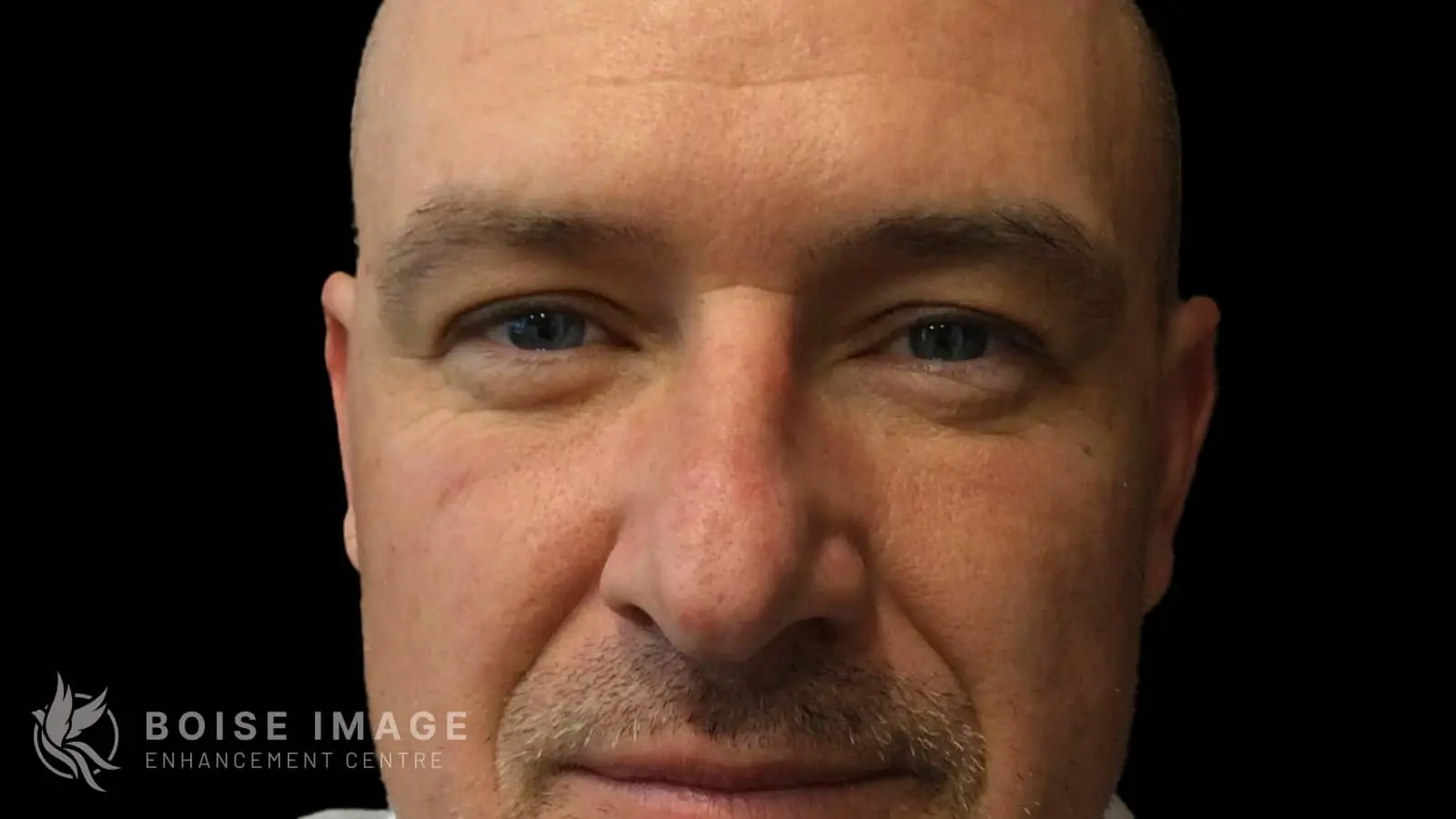 Forehead Dent Before