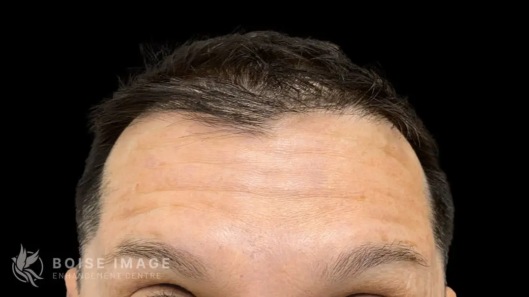 Forehead After