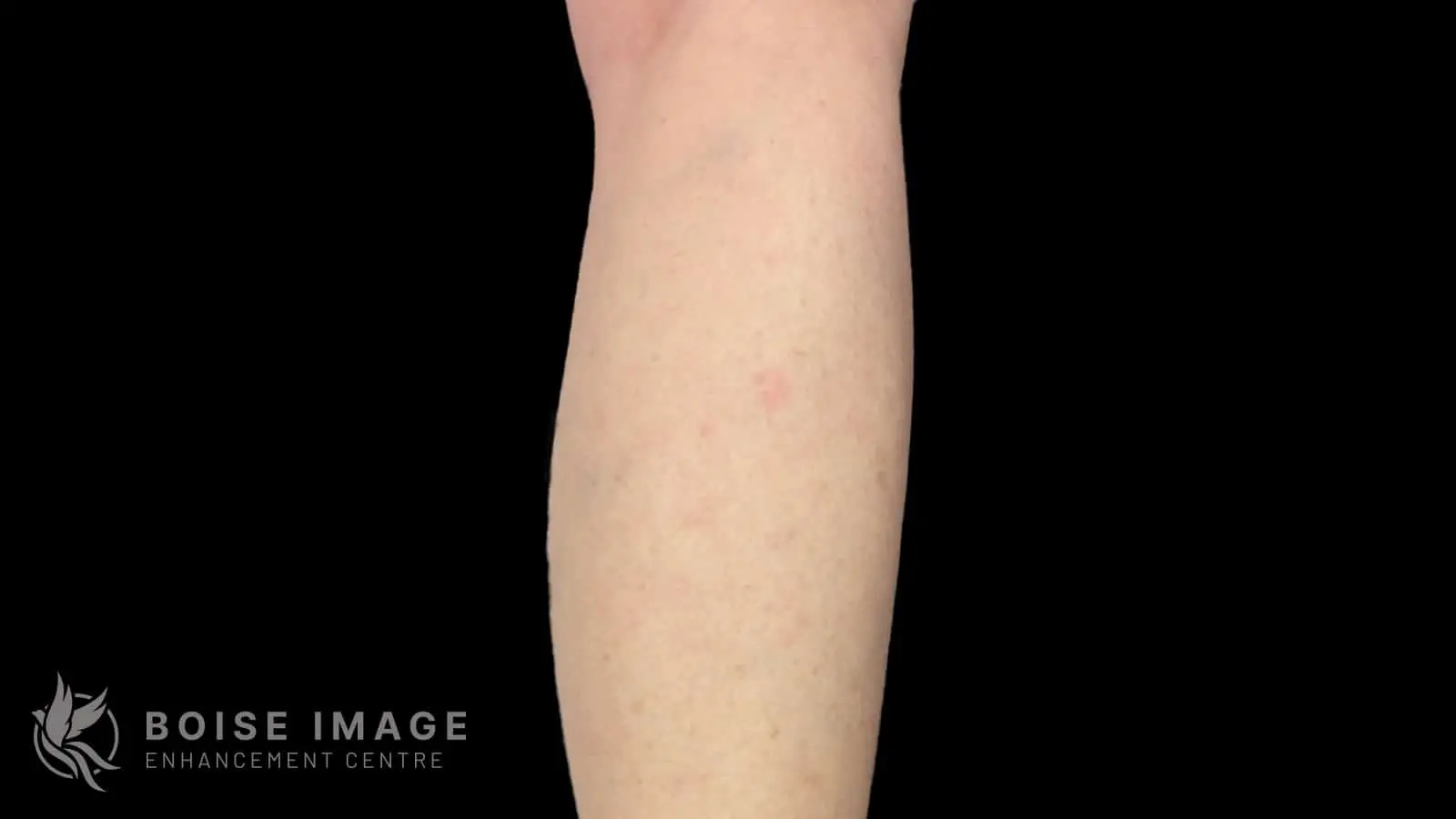 Anterior Thigh After