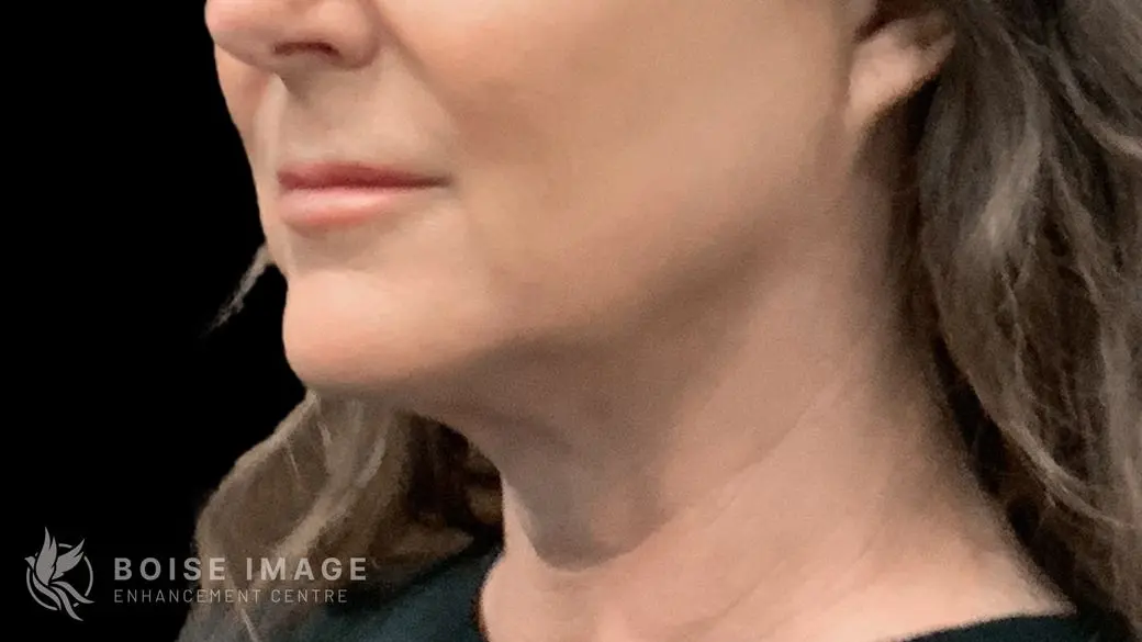 Jawline Chin After