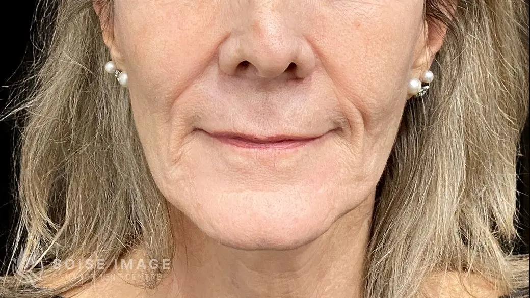 Lips Before