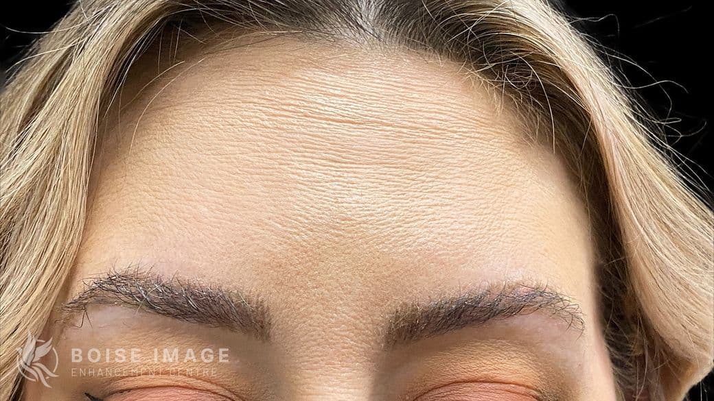 Forehead After