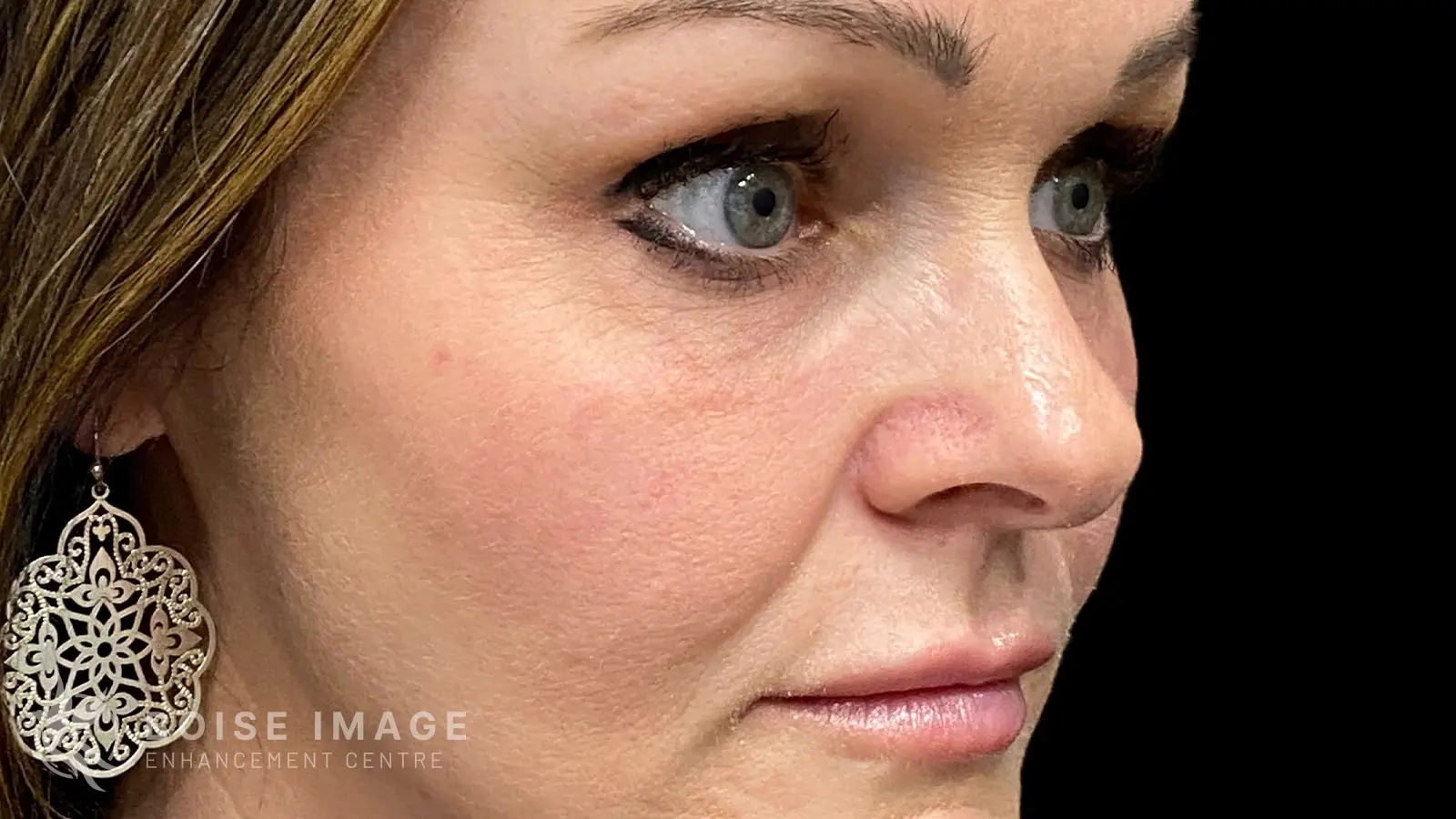 Under Eyes After