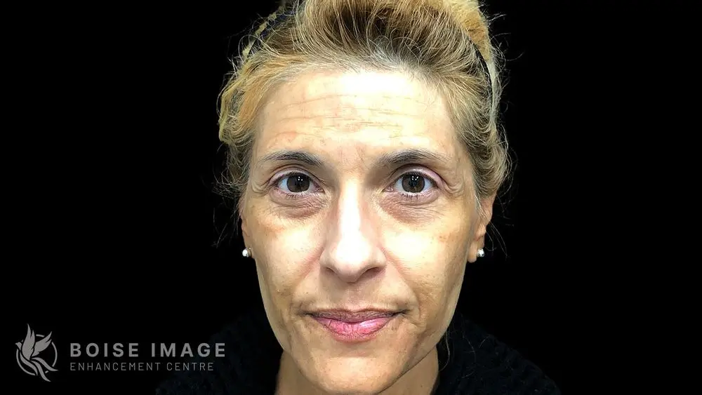 Light Lift Before