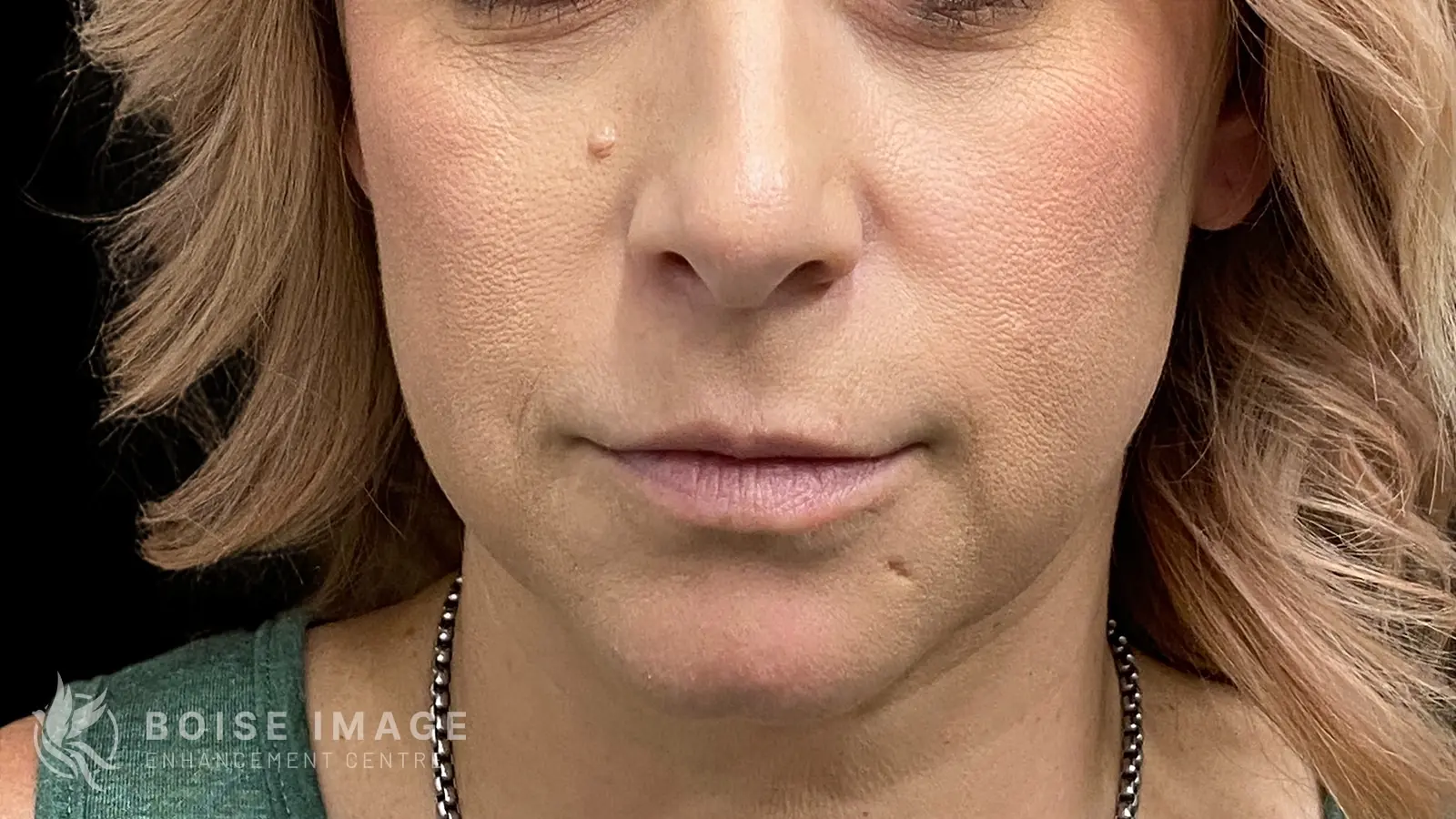 Cheeks Before
