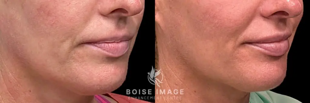 Volbella Lip Filler Before and After
