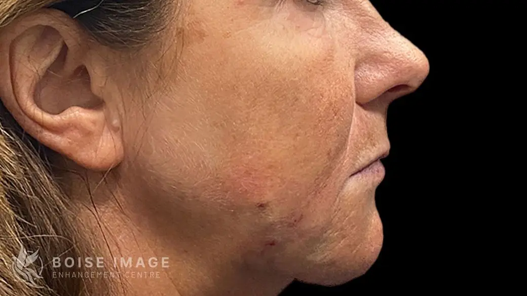 Lower Face After
