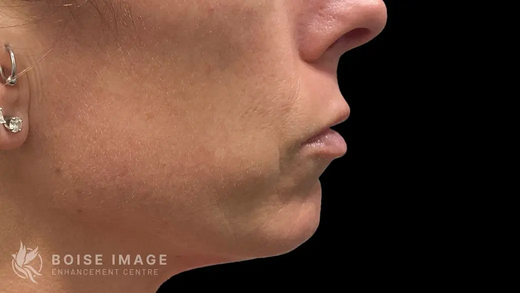 Lips After