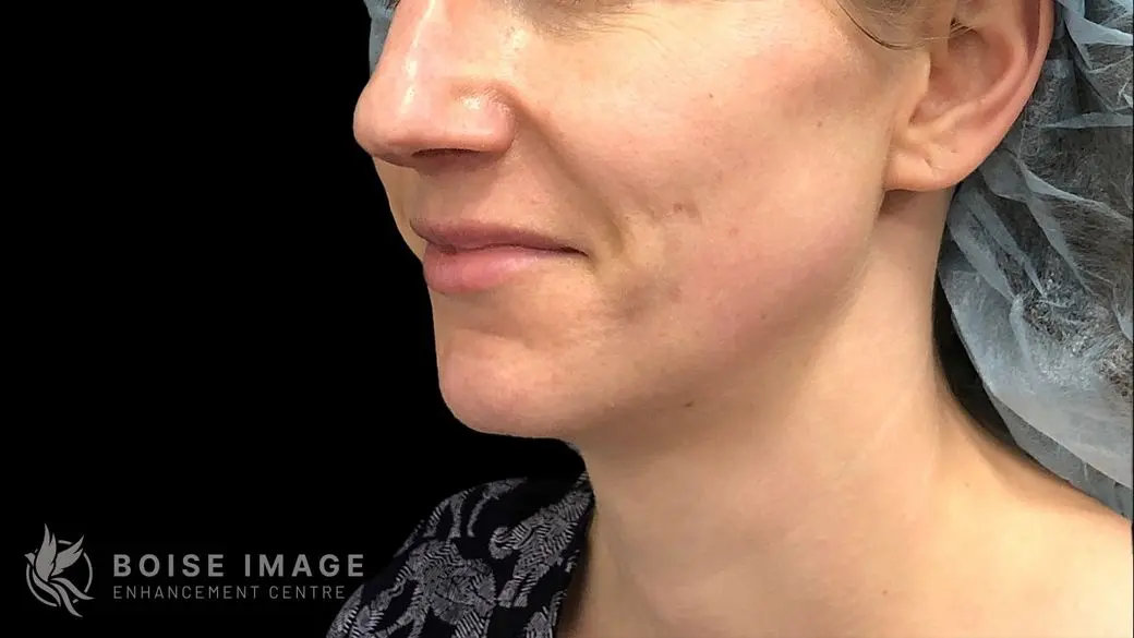 Lips Before