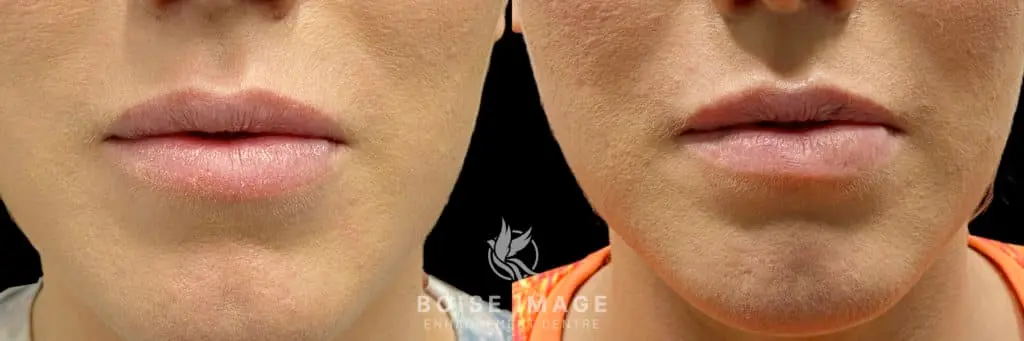 Lip Filler Dissolving Before and After - Treatment