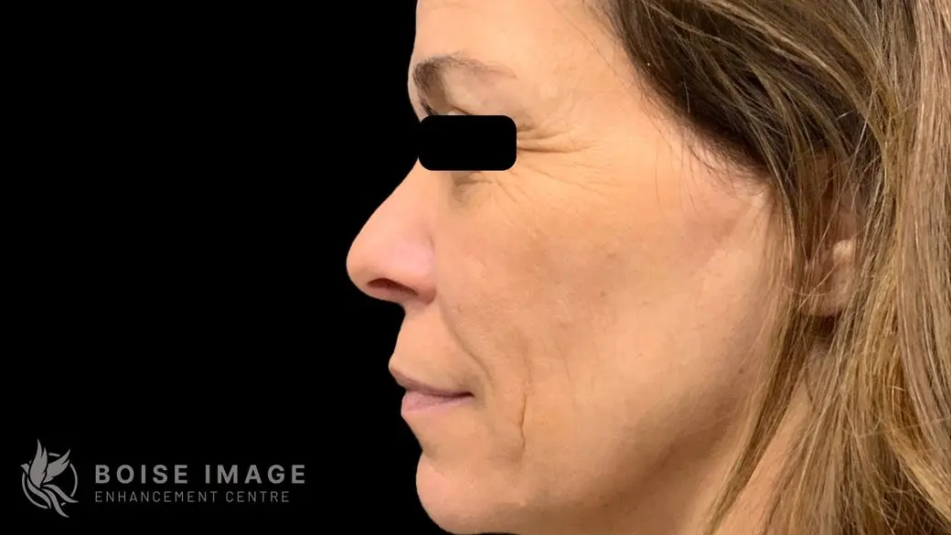 Full Face After