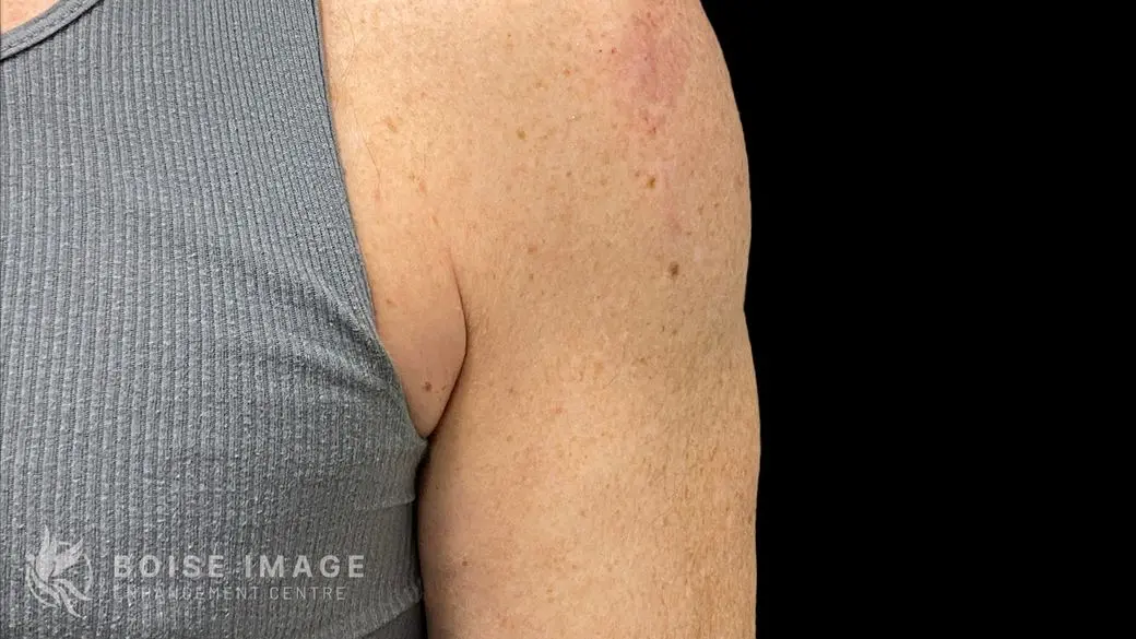 Right Shoulder Before