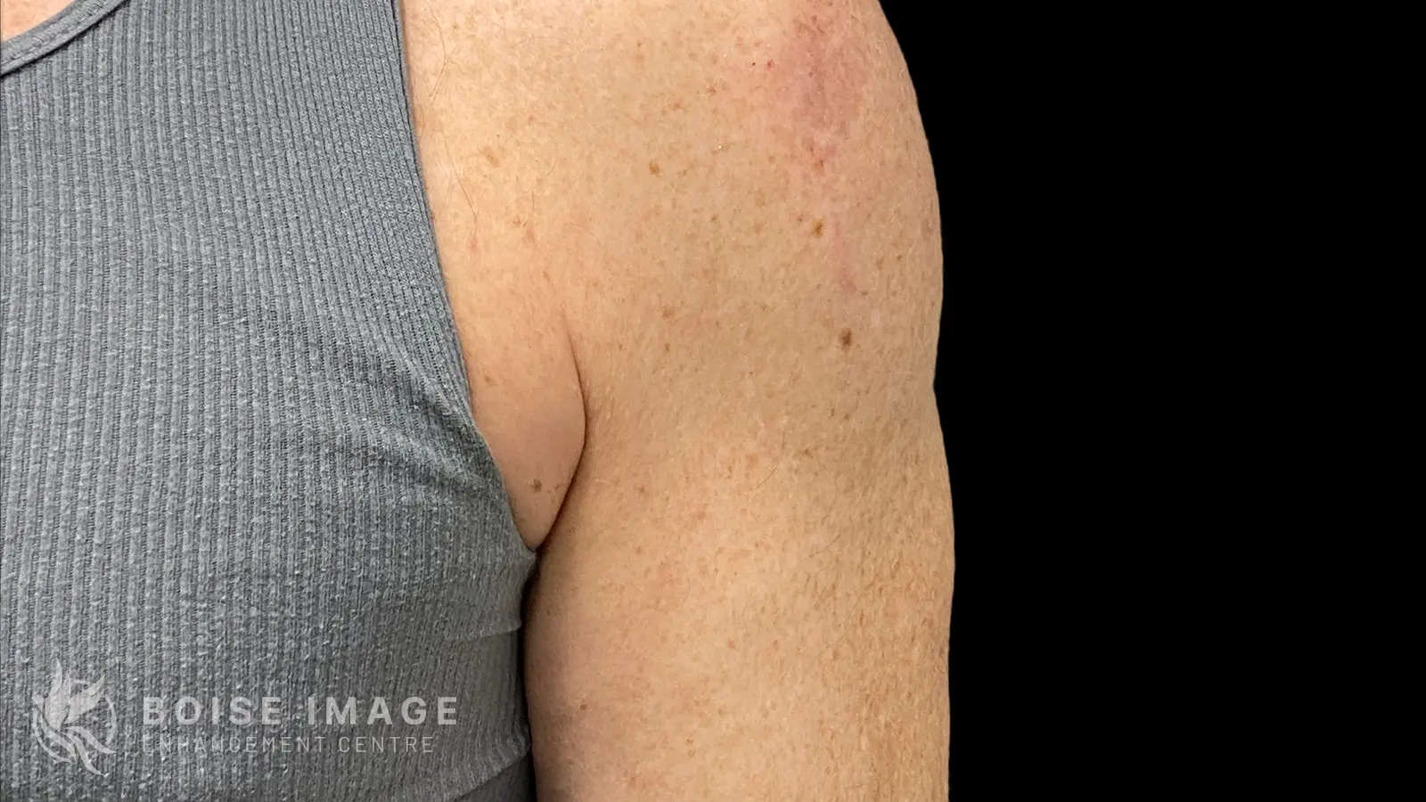 Right Shoulder Before