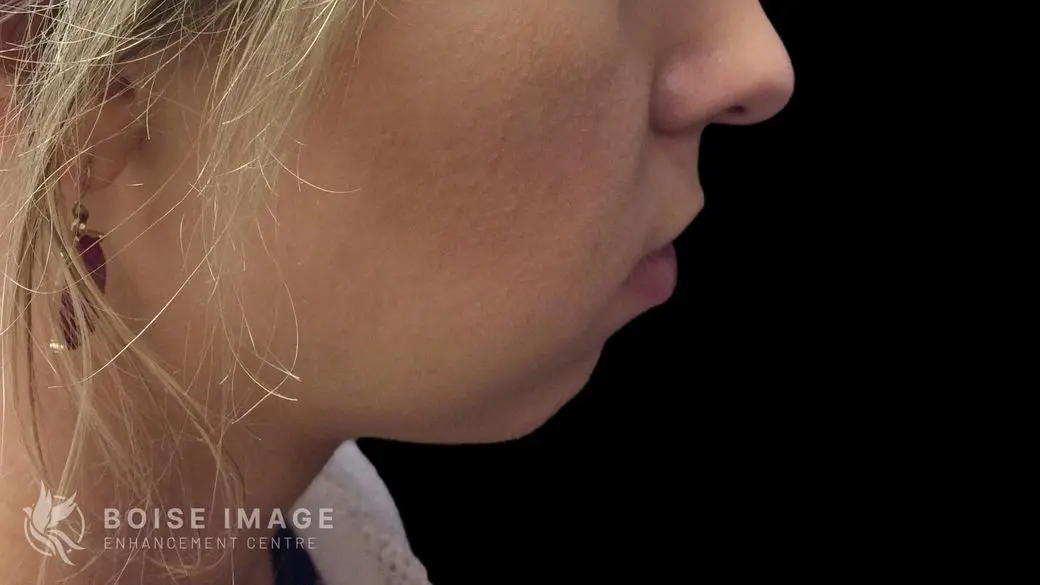 Kybella After
