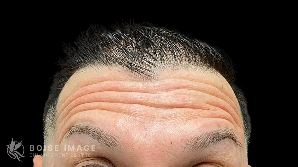 Forehead Before