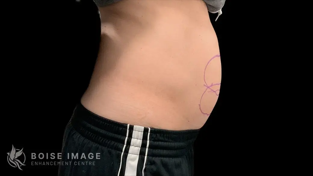 Abdomen Before