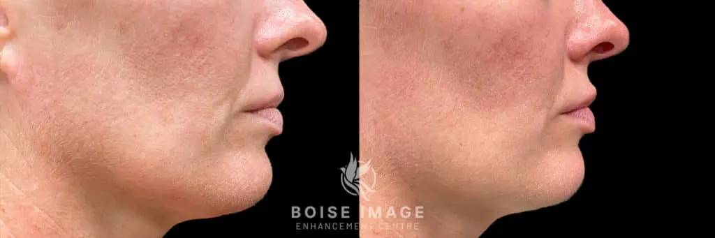 Volbella Lip Filler Before and After