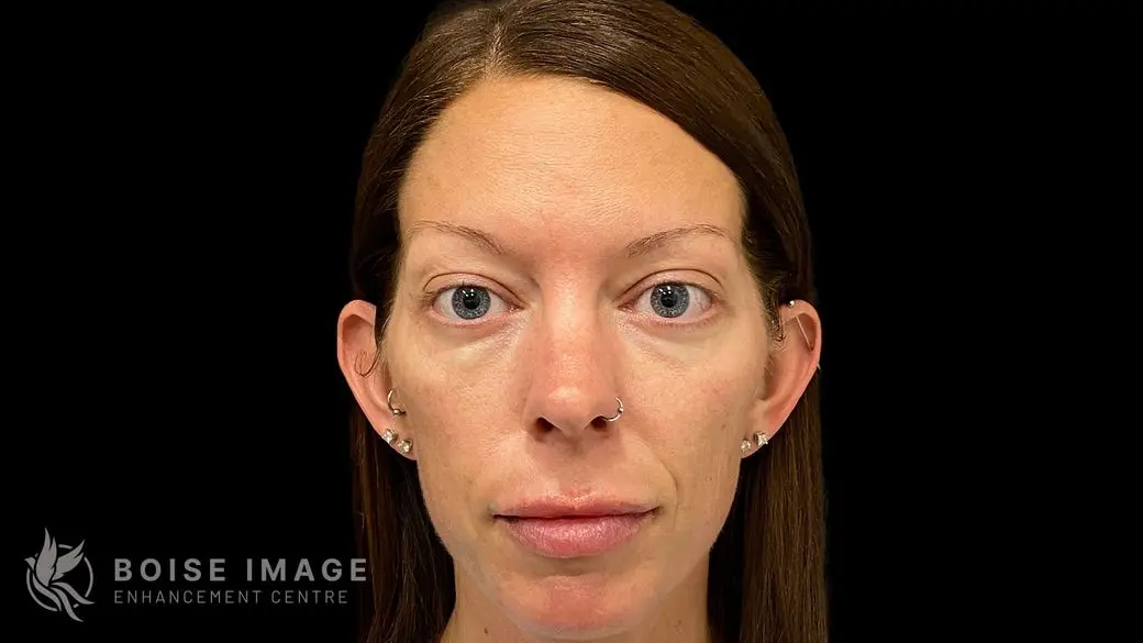 Cheek Filler Before
