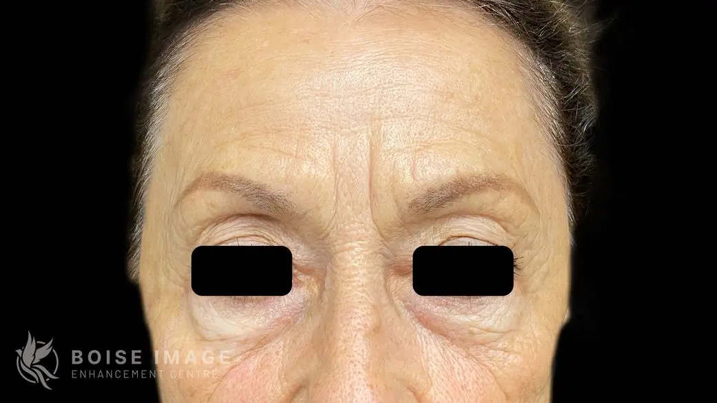 Glabella Before