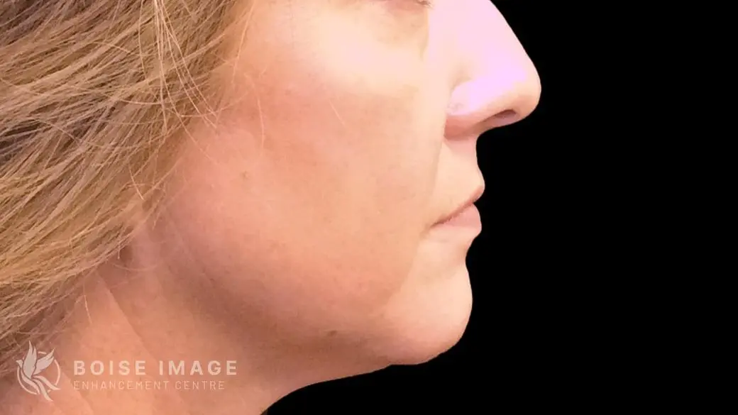 Lower Face After