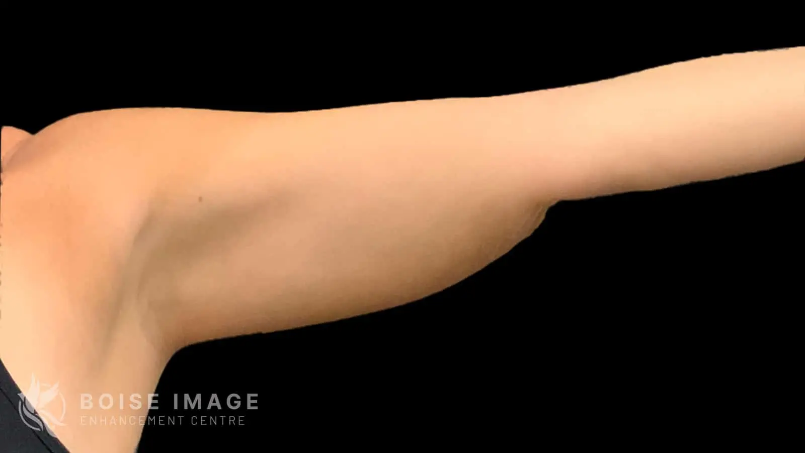 Left Arm After