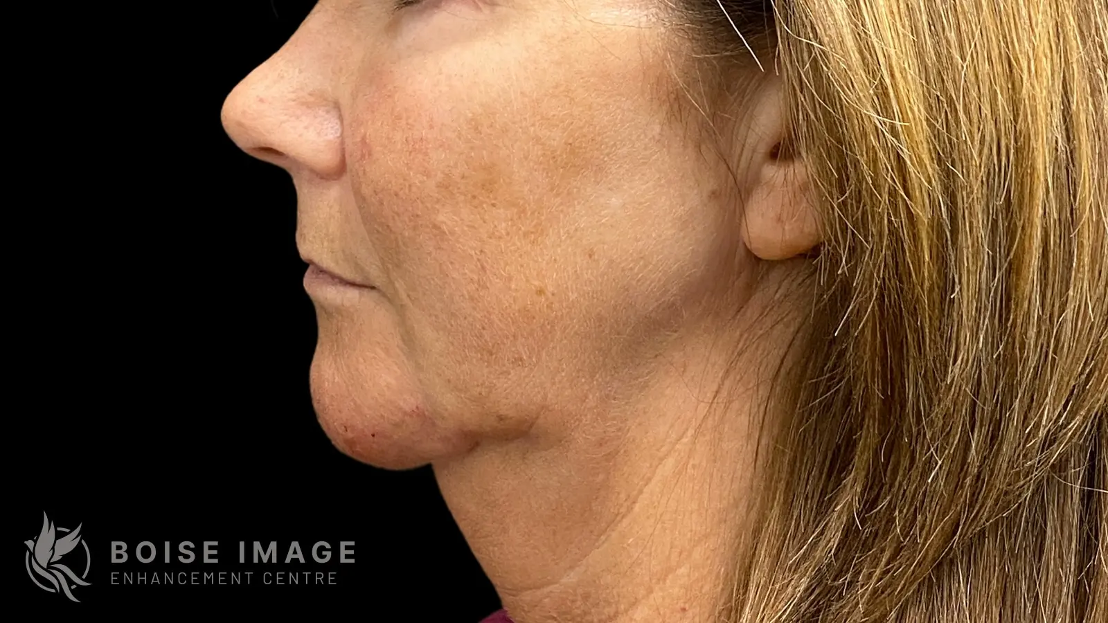Jawline & Chin After