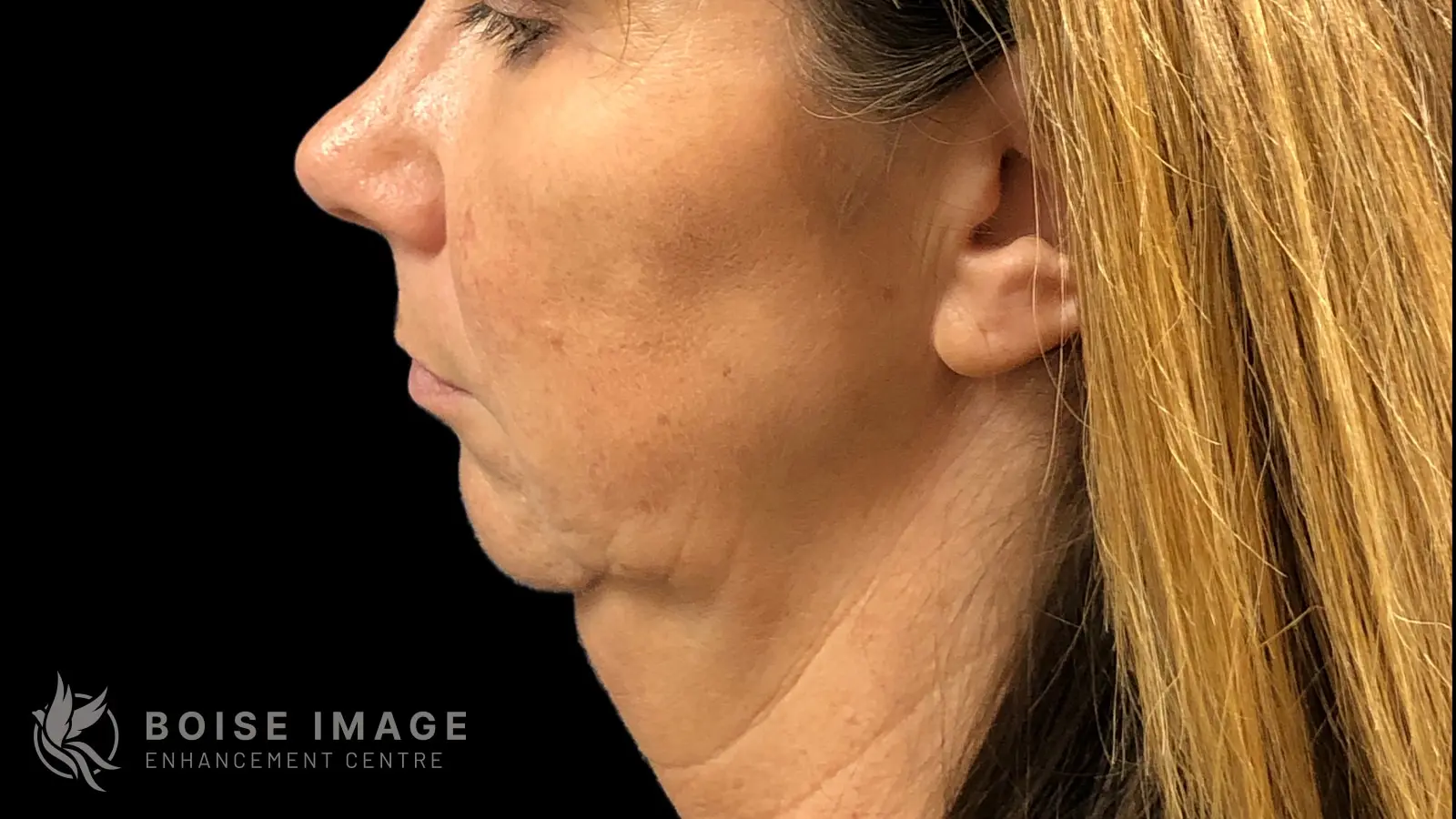 Jawline & Chin Before