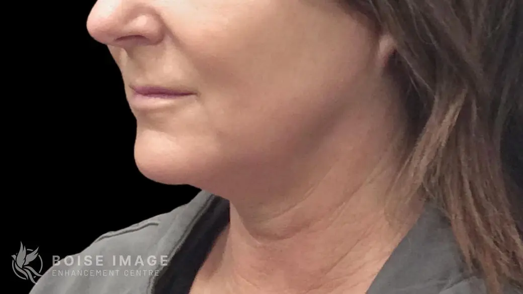 Jawline Chin Before