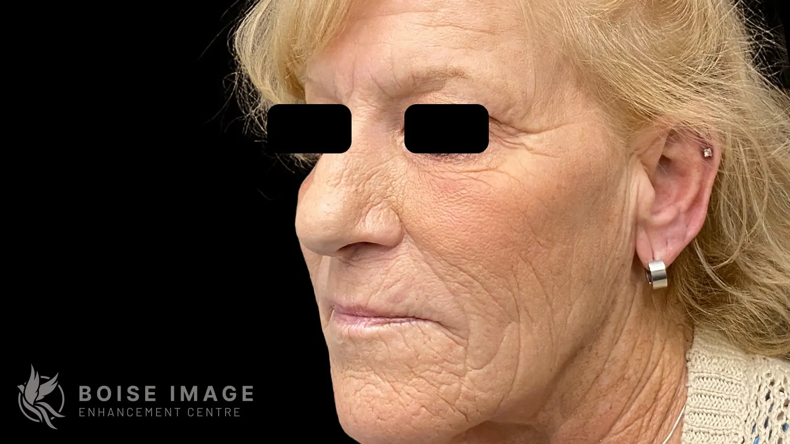 Facial Balancing Side After