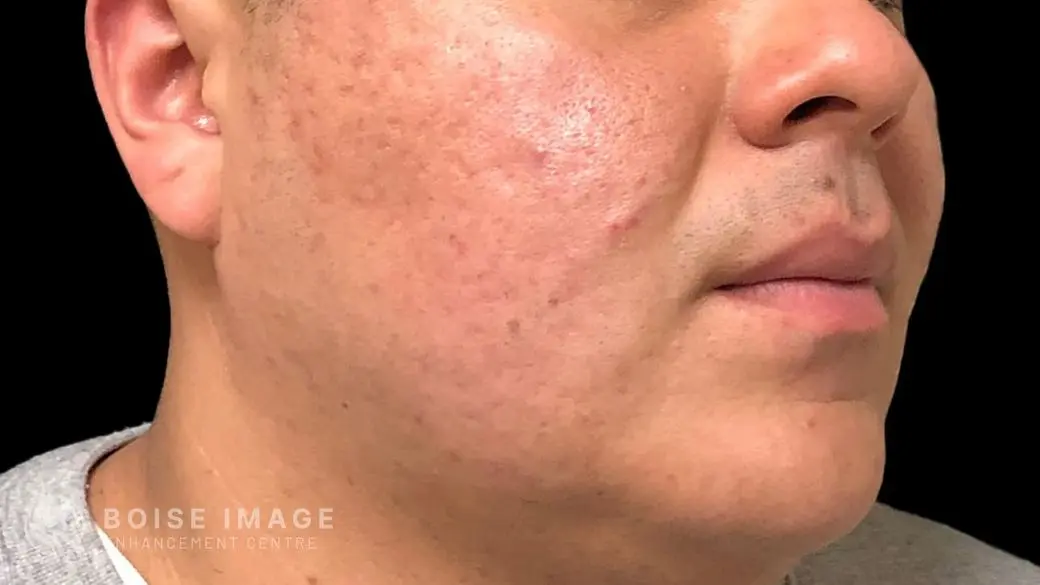 Cheeks Before