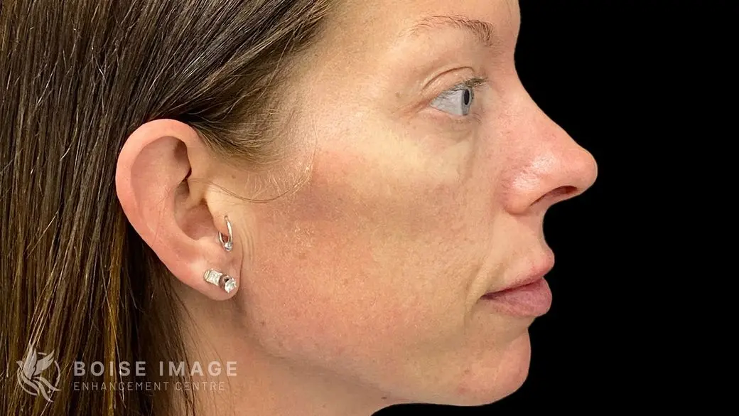 Cheeks Before