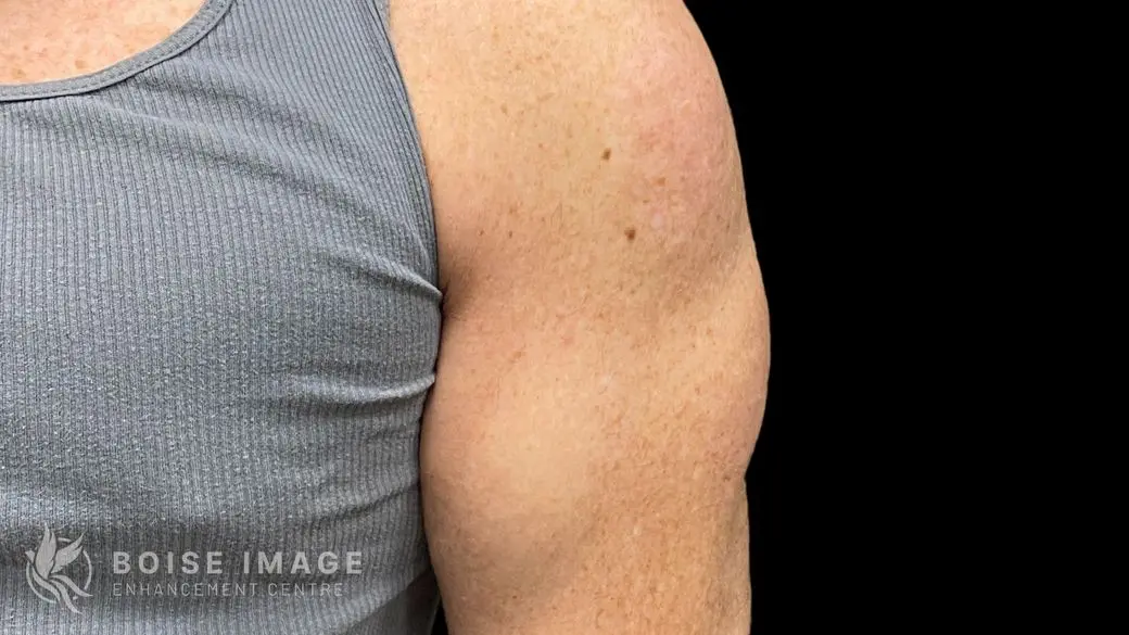 Right Shoulder After