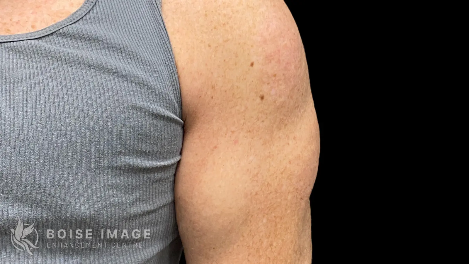 Right Shoulder After