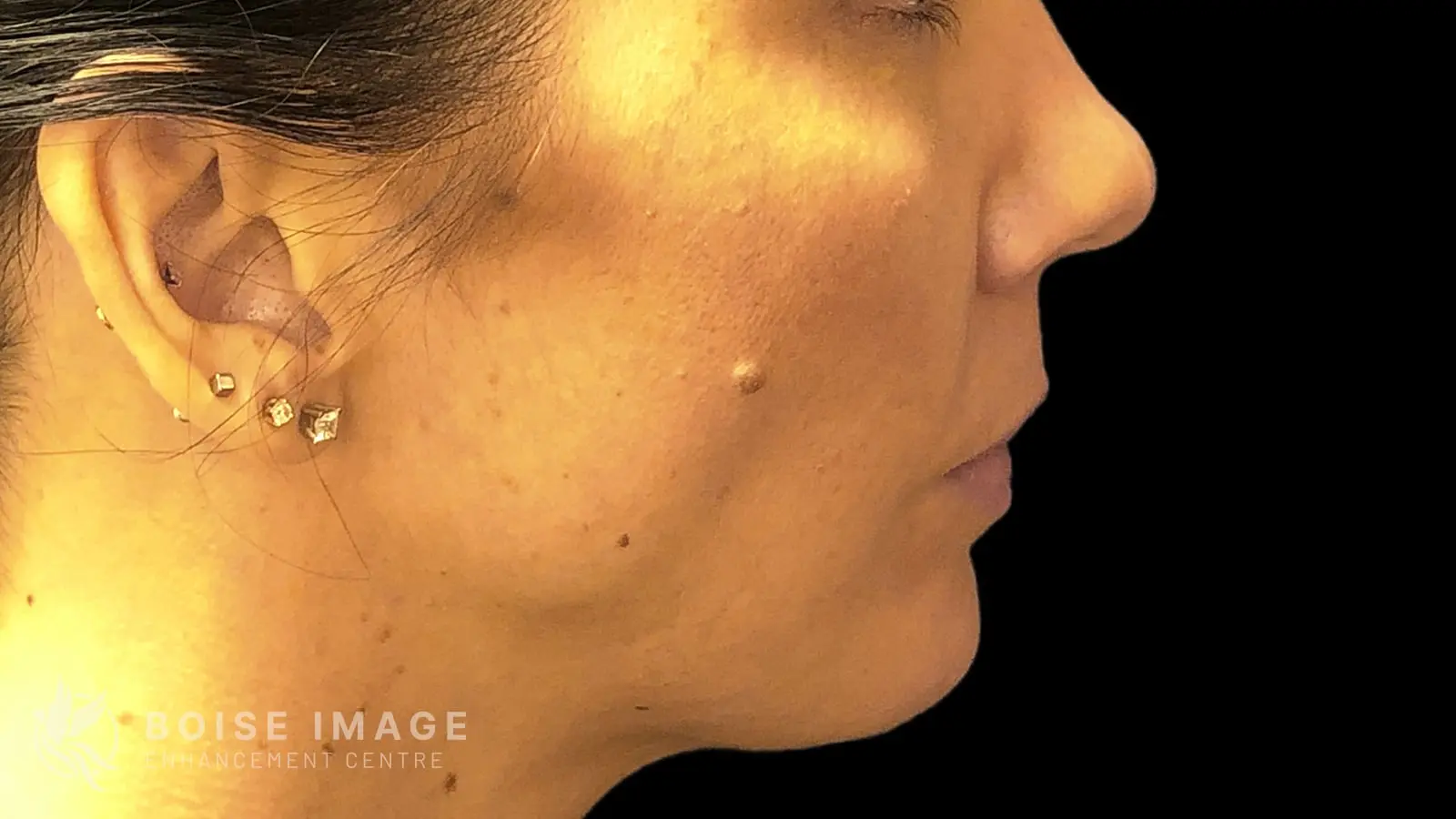 Chin Before