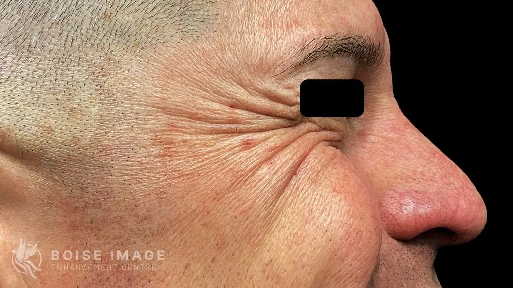 Crows Feet Before