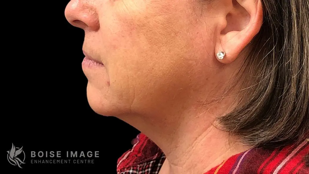 Kybella Before