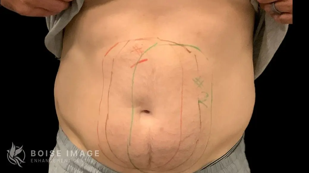 Abdomen Before