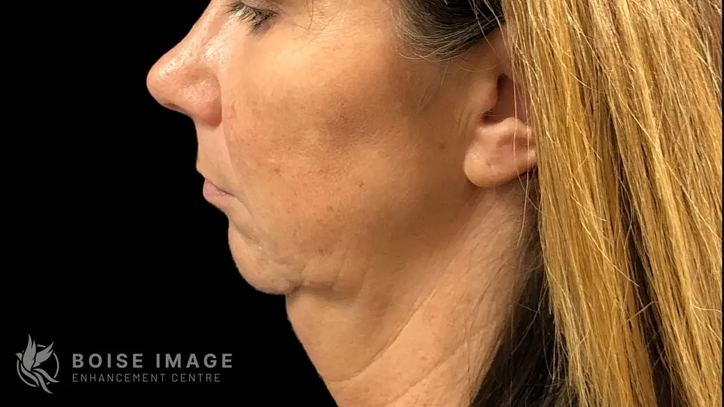 Jawline & Chin Before