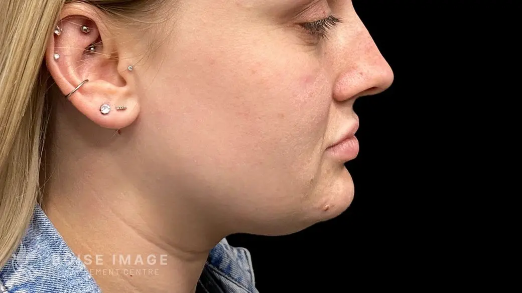 Submental After