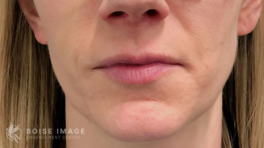 Lips After