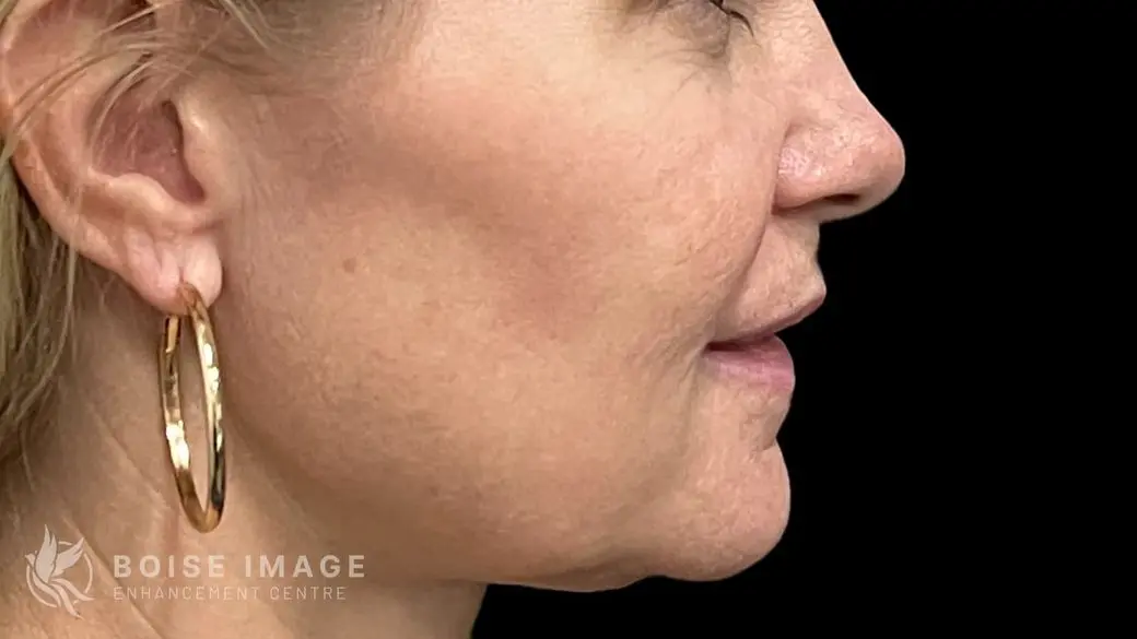 Lower Face After