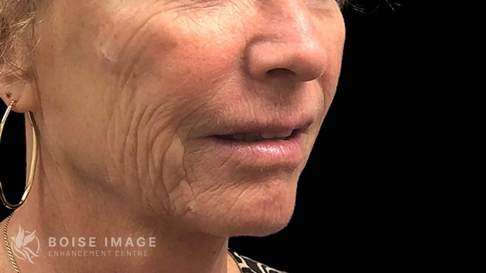 Lower Face Before