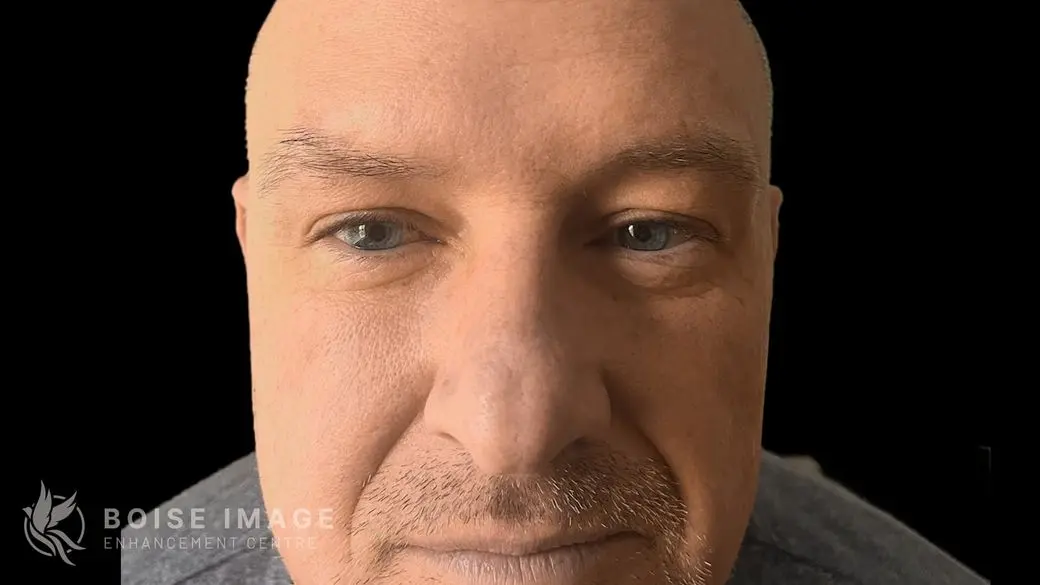 Forehead Dent After