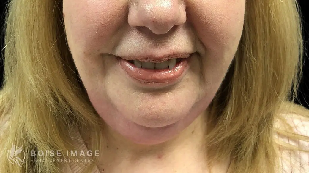 Kybella Before